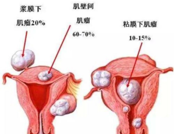 盆底肌修復(fù)